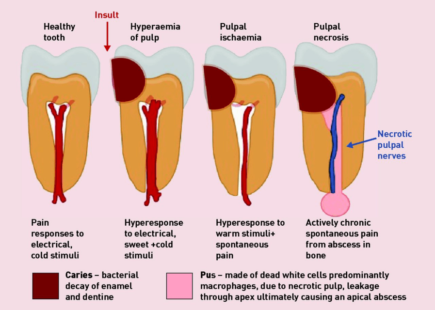 Referred Tooth Pain Chart - Caries