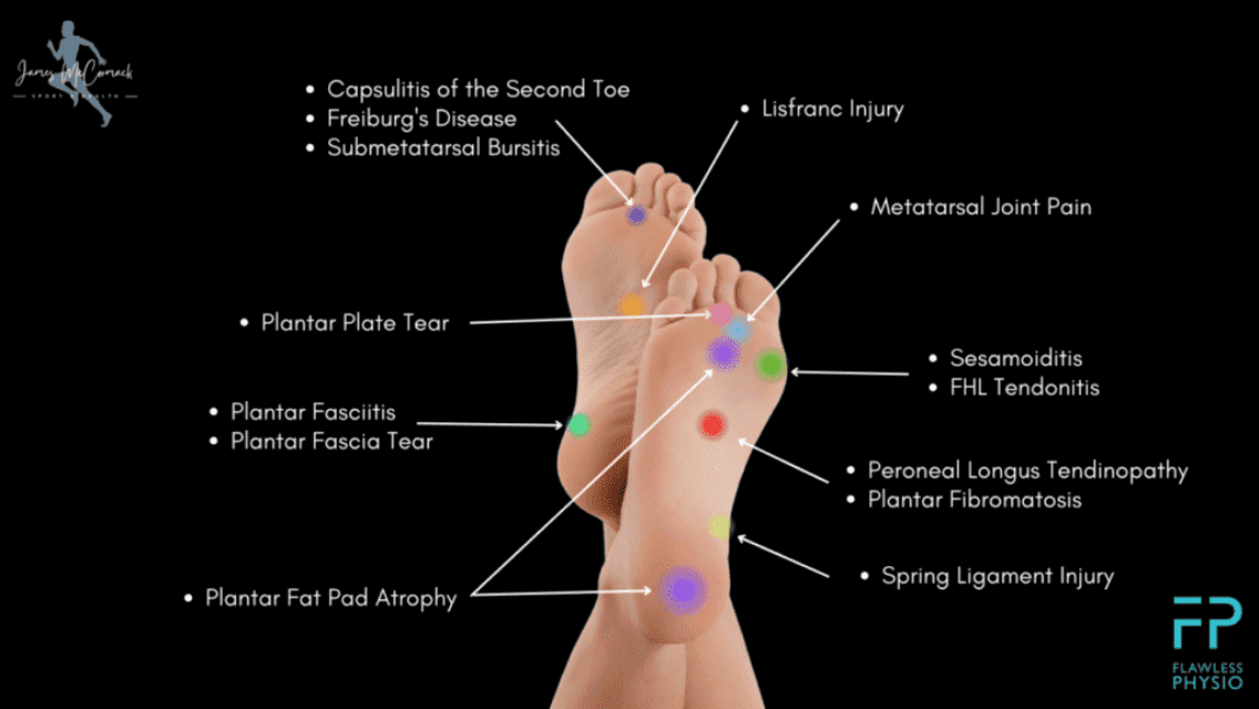 Foot Pain Chart - Flawless Physio