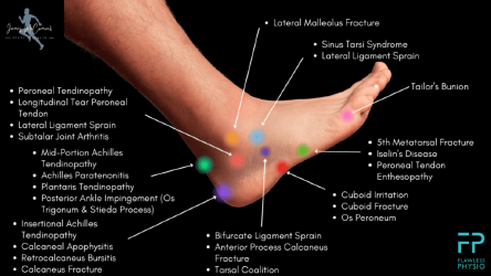 Document preview: Foot Pain Chart - Outer Side