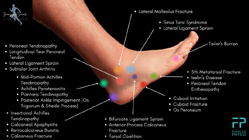 Foot Pain Chart - Outer Side, Page 1