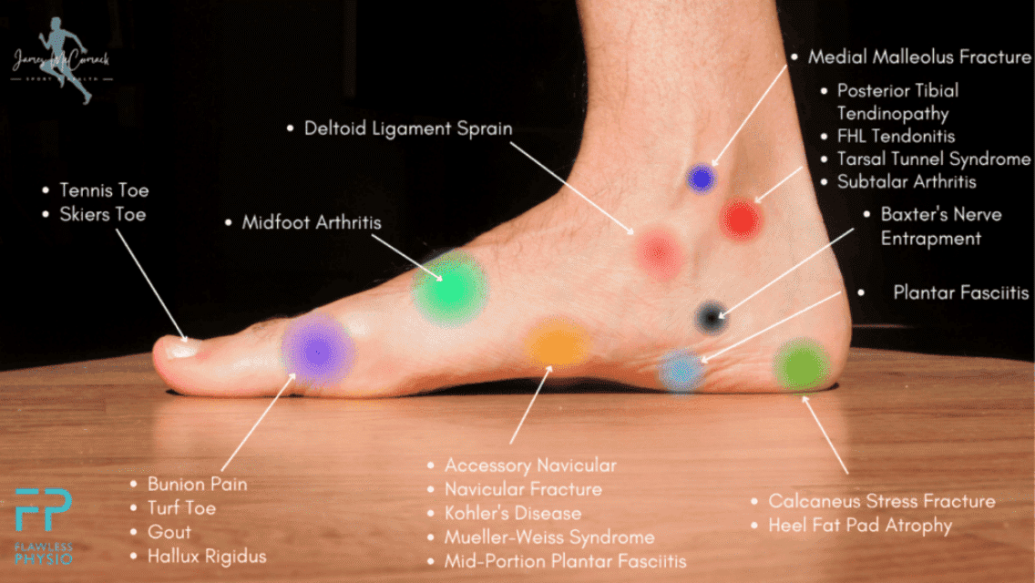 Foot Pain Chart - Inner Side Download Pdf