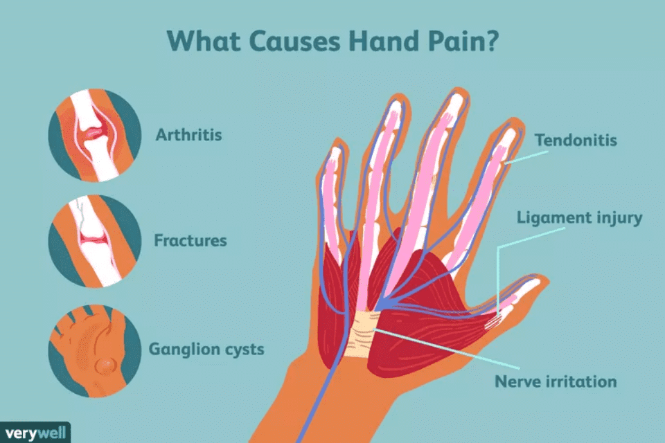 Hand Pain Chart - Causes