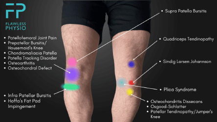 Document preview: Knee Pain Location Chart Template - Flawless Physio