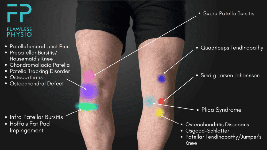 Knee Pain Location Chart Template - Flawless Physio