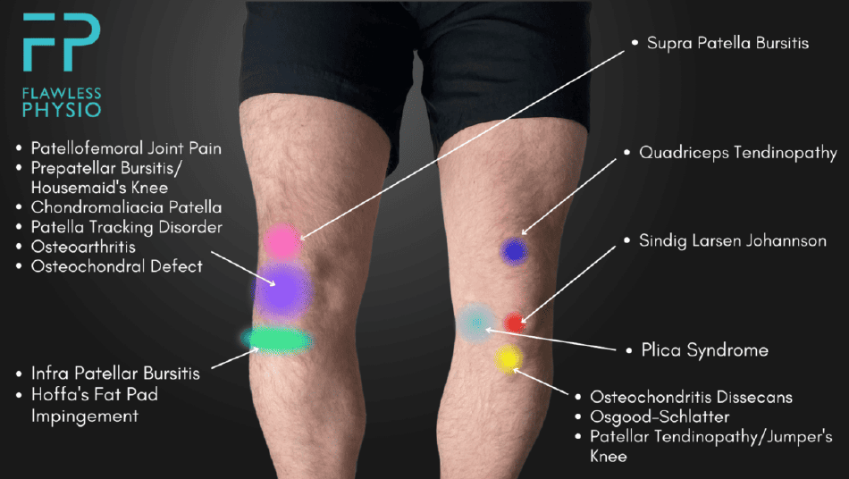 Knee Pain Location Chart Template - Flawless Physio Download Printable ...