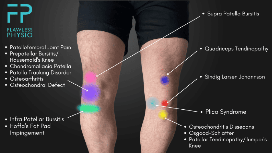 Knee Pain Location Chart Template - Flawless Physio, Page 1
