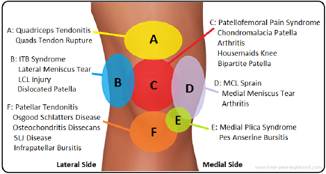 Document preview: Knee Pain Location Chart Template - Six Areas