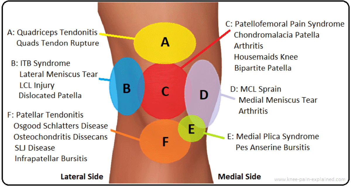 Knee Pain Location Chart Template - Six Areas