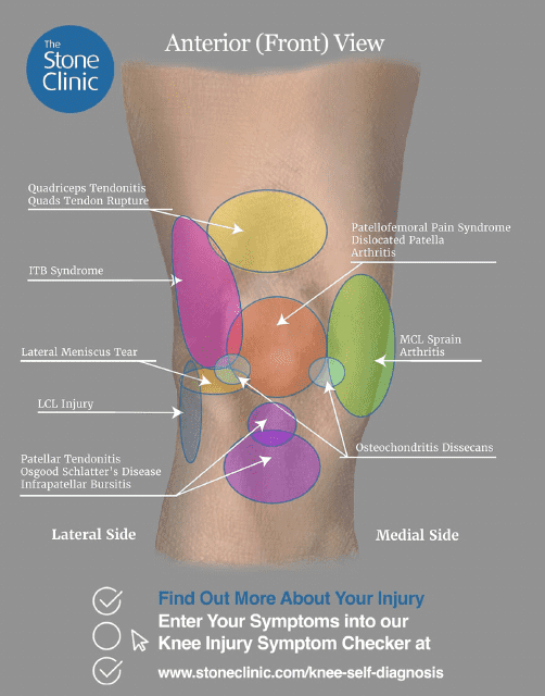 Knee Pain Location Chart Template - Anterior (Front) View