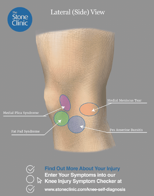 Knee Pain Location Chart Template - Lateral (Side) View