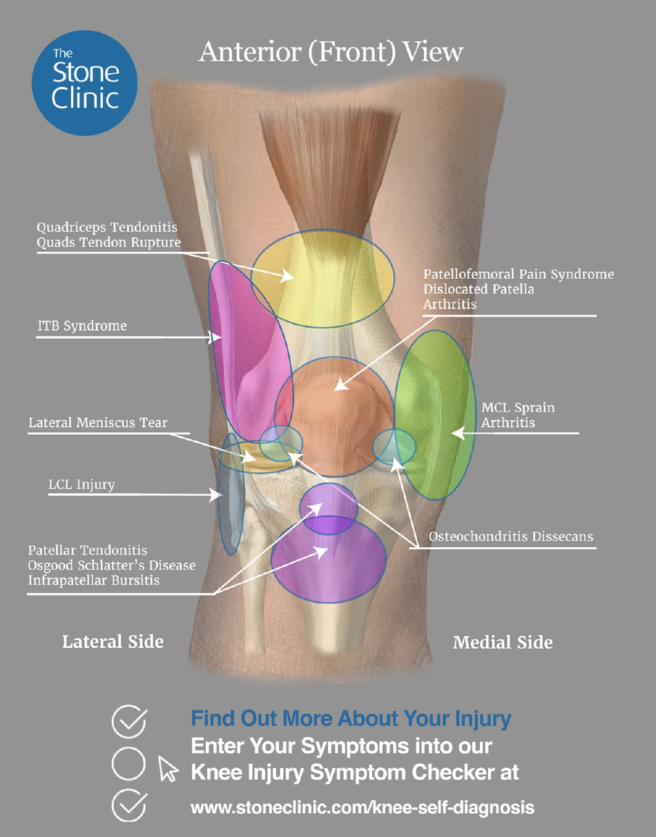 Knee Pain Location Chart Template - the Stone Clinic, Page 1