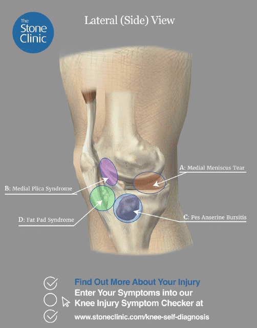 Knee Pain Location Chart Template - Four Areas