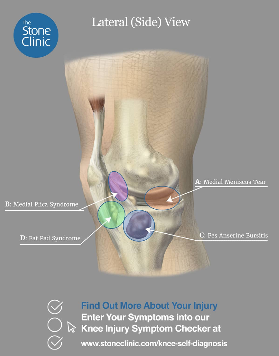 Knee Pain Location Chart Template - Four Areas Download Printable PDF ...