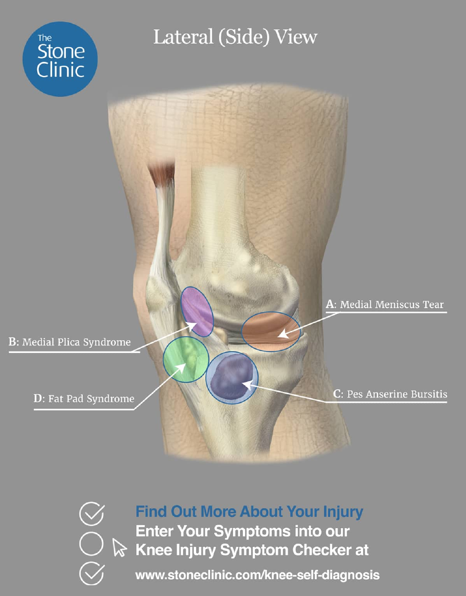 Knee Pain Location Chart Template - Four Areas, Page 1